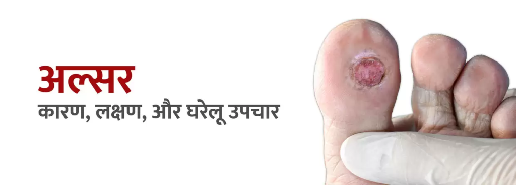 अल्सर से बचाव और उपचार के सरल उपाय